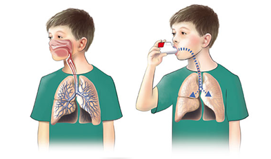 Inhalator behandling