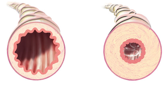Friskt och sjukt luftrör